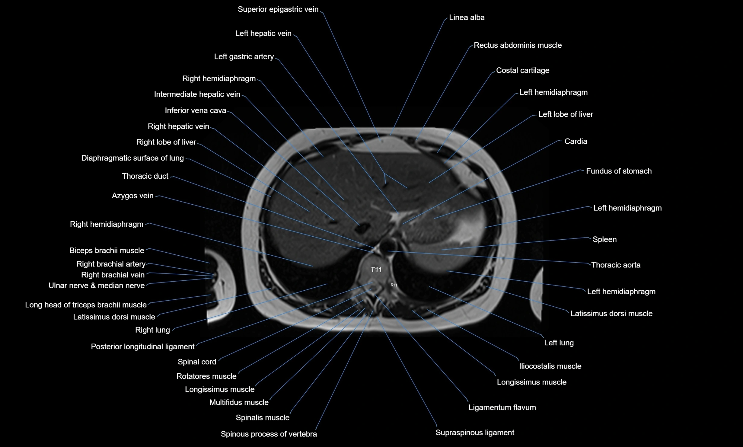 MRI chest axial  cross sectional anatomy 3T radiology  image-img-00001-00039.webp